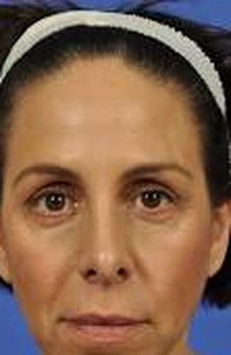 Botox + tear-trough filler after
