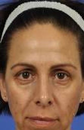 Botox + tear-trough filler before