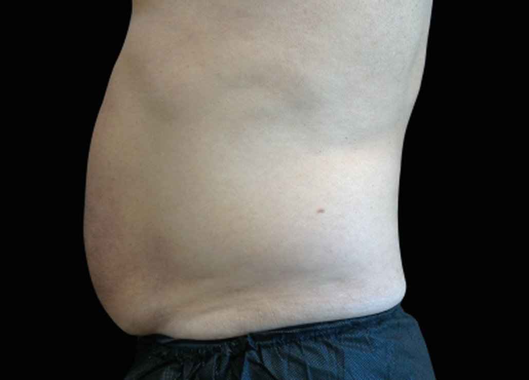 Emsculpt NEO after — 4 sessions