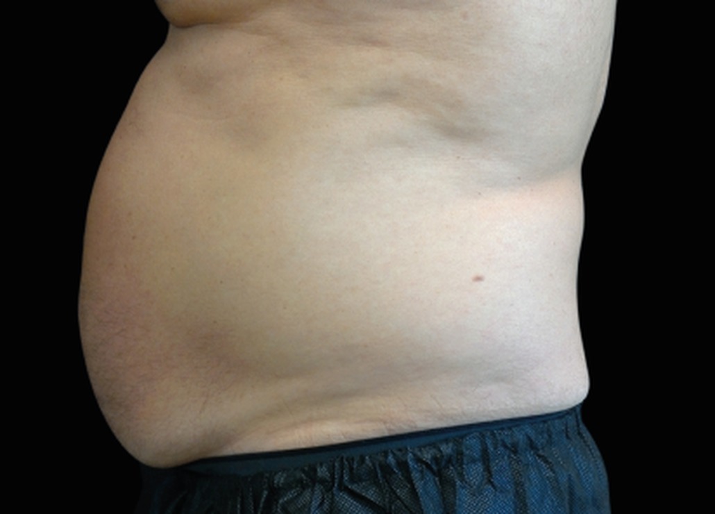 Emsculpt NEO before — abdomen